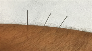 Dry Needling