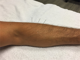 Dry Needling